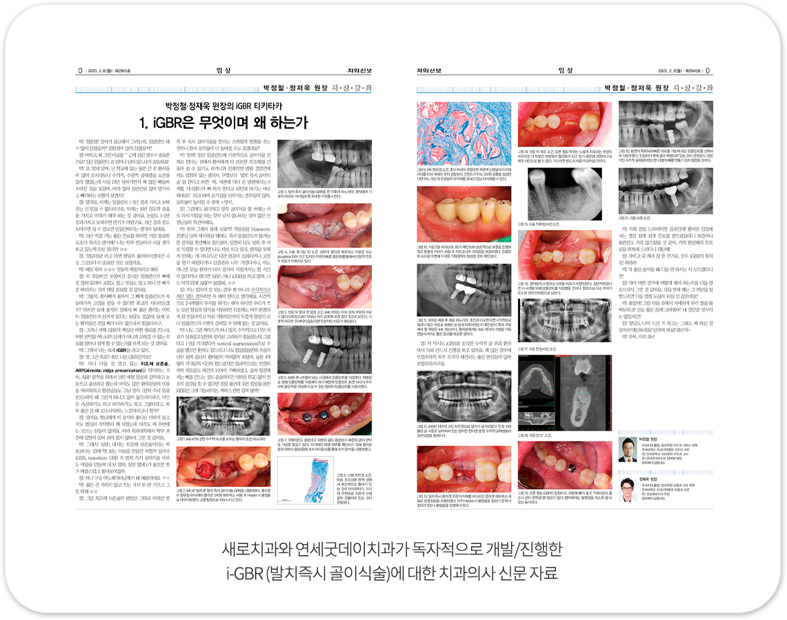 i-GBR에 대한 치과의사 신문 자료