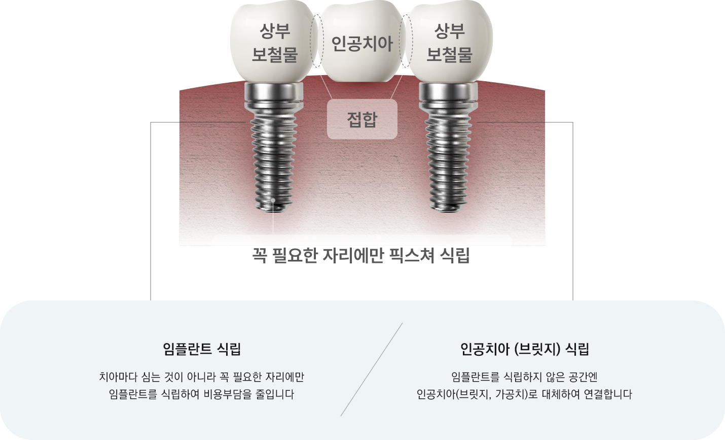 꼭 필요한 자리에만 픽스쳐 식립, 임플란트 식립 치아마다 심는 것이 아니라 꼭 필요한 자리에만 임플란트를 식립하여 비용부담을 줄입니다. 인공치아 (브릿지 식립) 임플란트를 식립하지 않은 공간엔 인공치아(브릿지,가공치)로 대체하여 연결합니다.