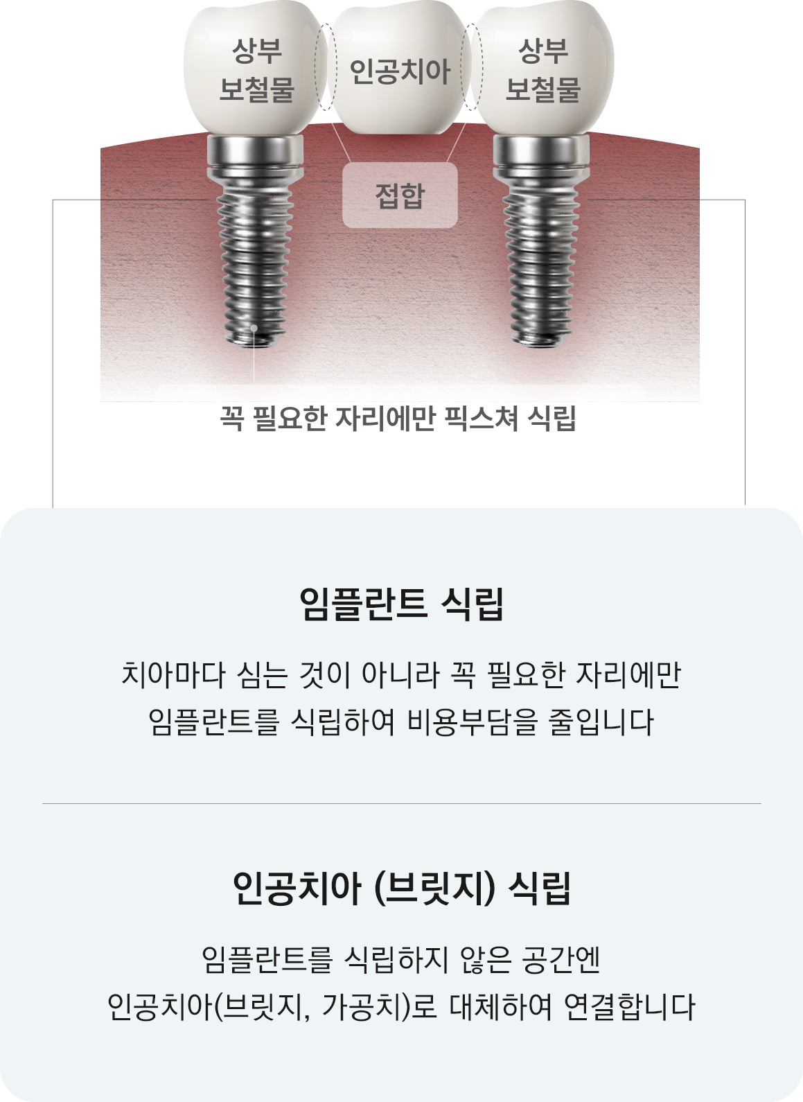 꼭 필요한 자리에만 픽스쳐 식립, 임플란트 식립 치아마다 심는 것이 아니라 꼭 필요한 자리에만 임플란트를 식립하여 비용부담을 줄입니다. 인공치아 (브릿지 식립) 임플란트를 식립하지 않은 공간엔 인공치아(브릿지,가공치)로 대체하여 연결합니다.
