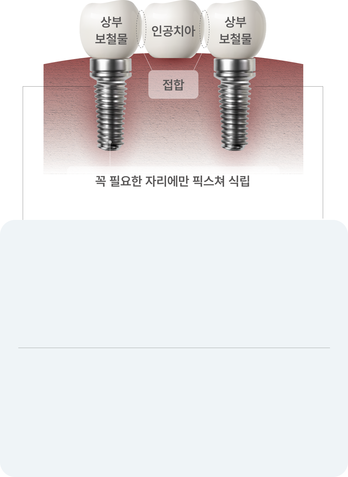 꼭 필요한 자리에만 픽스쳐 식립