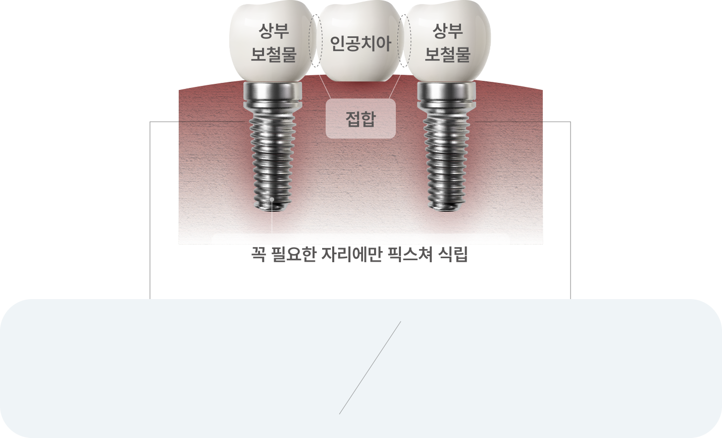 꼭 필요한 자리에만 픽스쳐 식립