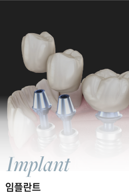 Implant 임플란트