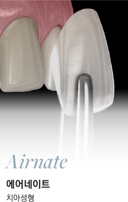 Airnate 에어네이트 치아성형