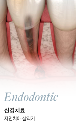 Endodontic 신경치료 자연치아 살리기