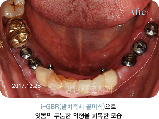i-GBR(발치즉시 골이식)으로 잇몸의 두툼한 외형을 회복한 모습