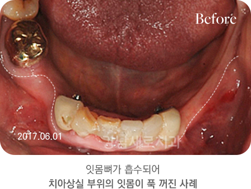 잇몸뼈가 흡수되어 치아상실 부위의 잇몸이 푹 꺼진 사례