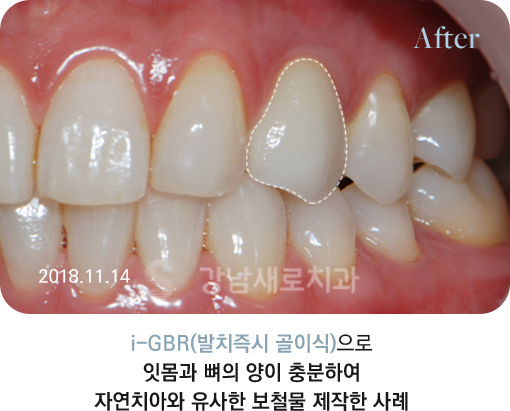 i-GBR(발치즉시 골이식)으로 잇몸과 뼈의 양이 충분하여 자연치아와 유사한 보철물 제작한 사례