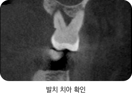 발치 치아 확인