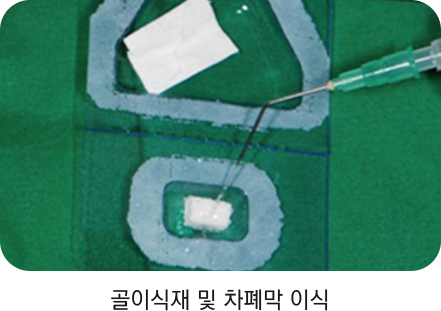 골이식재 및 차폐막 이식
