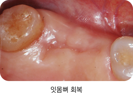 잇몸뼈 회복