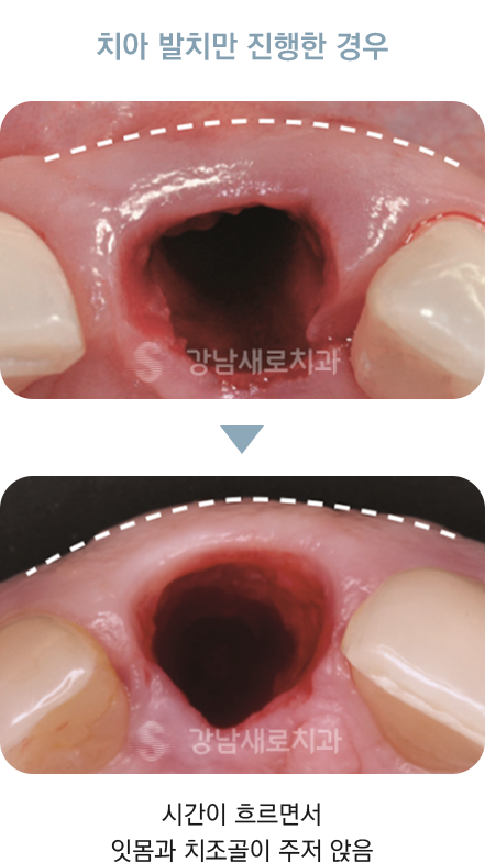 치아 발치만 진행한 경우 시간이 흐르면서 잇몸과 치조골이 주저 앉음