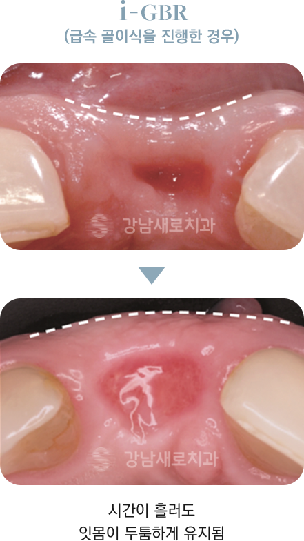 i-GBR(급속 골이식을 진행한 경우) 시간이 흘러도 잇몸이 두툼하게 유지됨