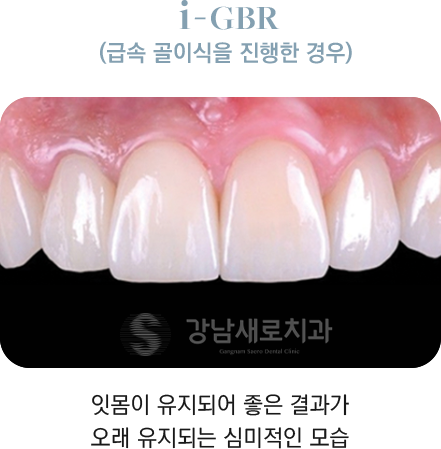 i-GBR(급속 골이식을 진행한 경우) 잇몸이 유지되어 좋은 결과가 오래 유지되는 심미적인 모습