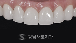 라미네이트 치료 후 앞니 사진(사례 4)
