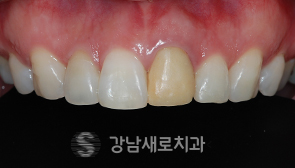 라미네이트 치료 전 앞니 사진(사례 2)