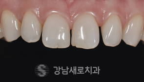 라미네이트 치료 전 앞니 사진(사례 4)